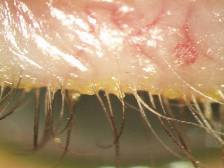 Blepharitis Demodex And Blephex Earlam And Christopher 